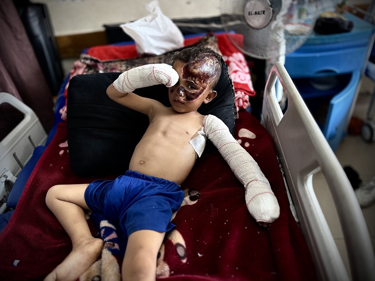İsrail'in Gazze'deki çadırlarına düzenlediği saldırıda ağır yaralanan 4 yaşındaki Ahmed Ebu...