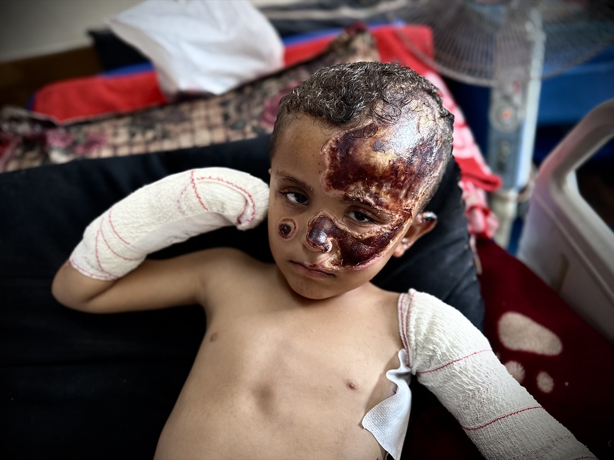 İsrail'in Gazze'deki çadırlarına düzenlediği saldırıda ağır yaralanan 4 yaşındaki Ahmed Ebu...