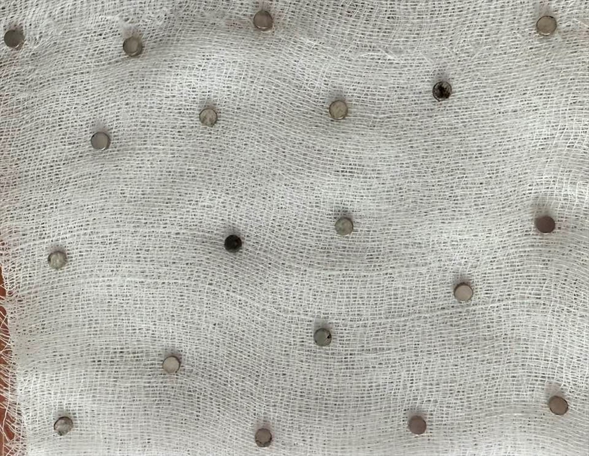 Elazığ'da 3 yaşındaki çocuğun yuttuğu ve yemek borusunu tıkayan 19 mıknatıs, Fırat Üniversitesi...